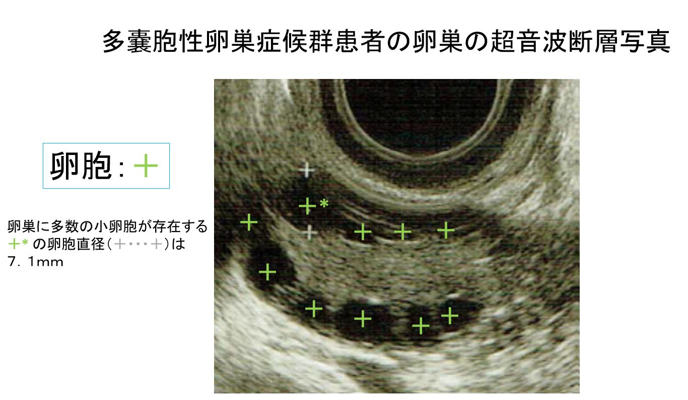 不妊の原因となる多嚢胞性卵巣症候群（PCOS）～その治療法と自分で出来ること～ | ワンモア・ベイビー・ラボ