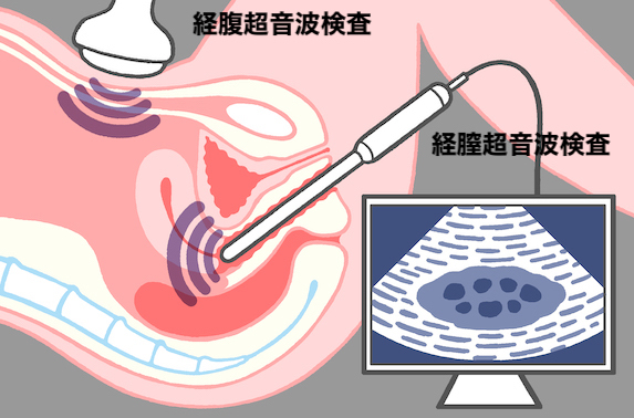 同行取材・体験談]何がわかる？痛みは？経腟エコー検査（経腟超音波検査）を不妊治療で体験 | ワンモア・ベイビー・ラボ